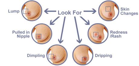 breast cancer 