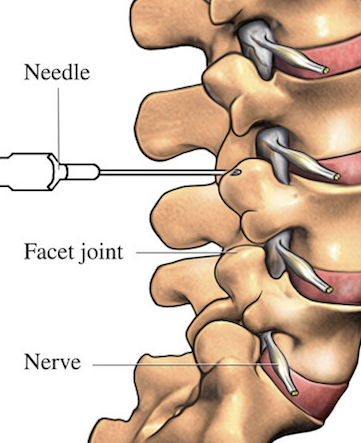 Injections for Pain Management