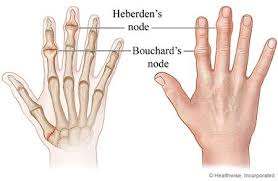 Osteoporosis and Nutrition