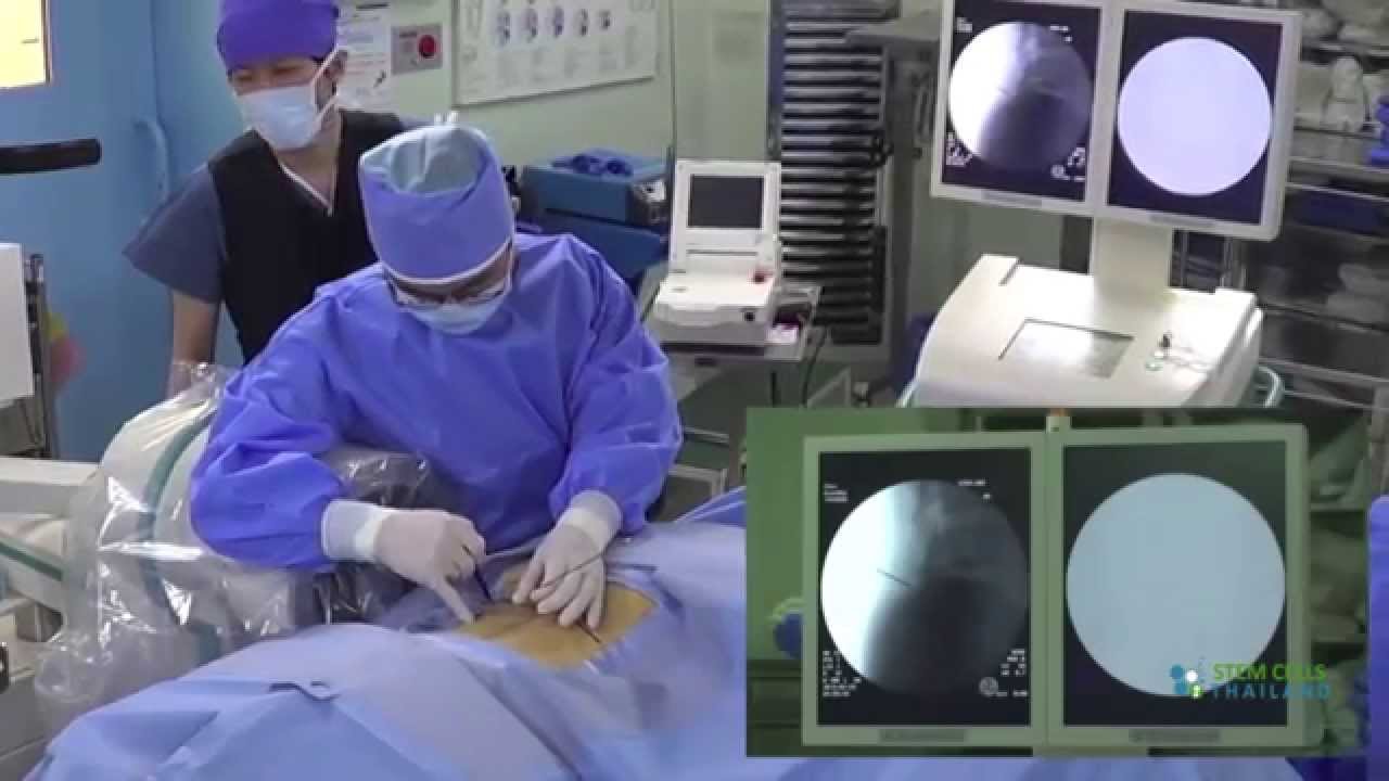 stem cell therapy
