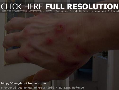 lyme-disease-pictures