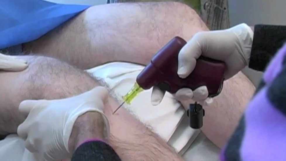 stem cell therapy